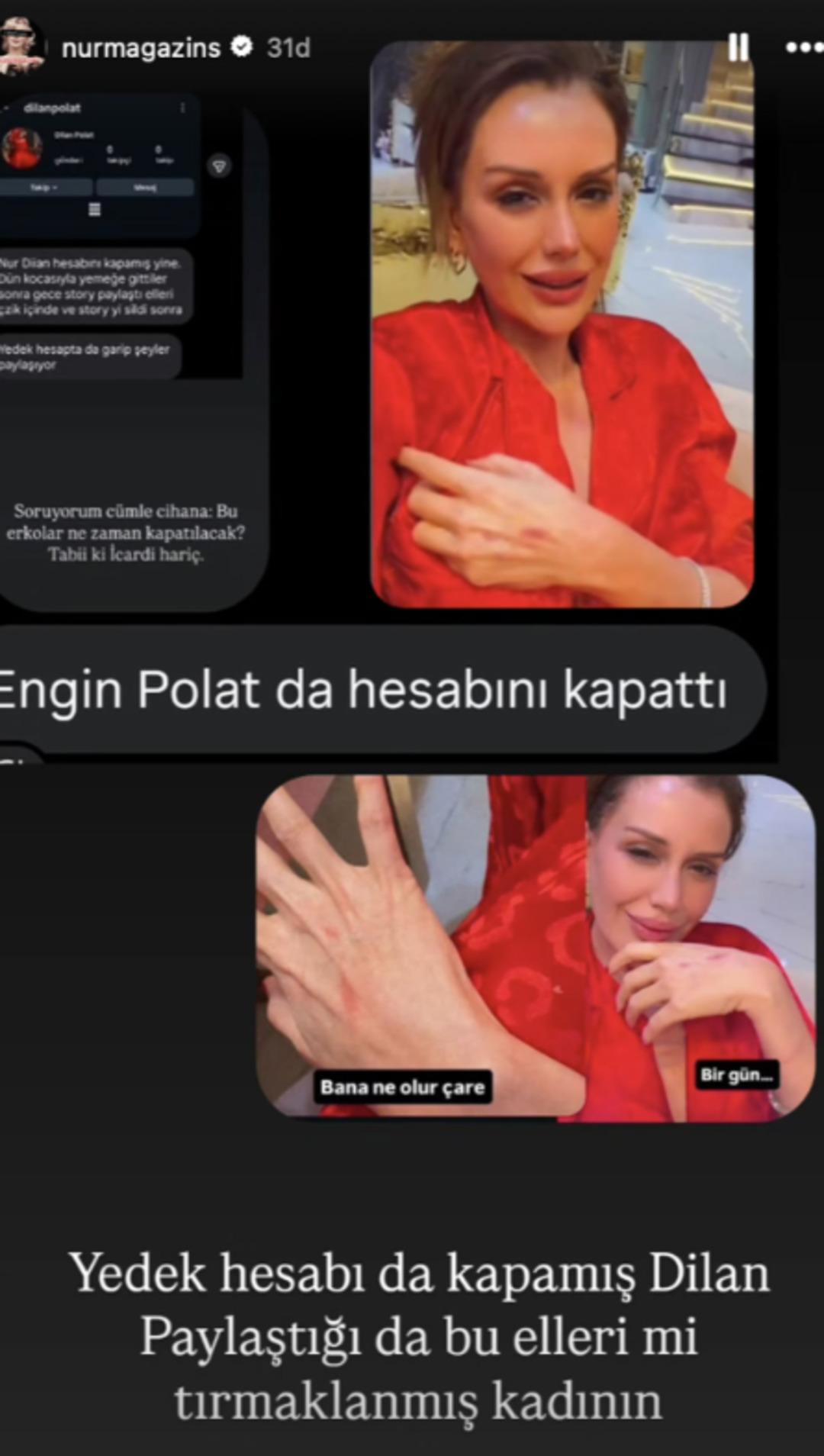 Dilan Polat ın ellerinin hali dikkat &ccedil;ekti! Hesabını kapattı:  Bana ne olur &ccedil;are  2