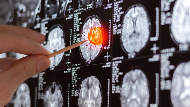 Bu belirtilere dikkat: Beyin tümörünün ilk sinyali olabilir