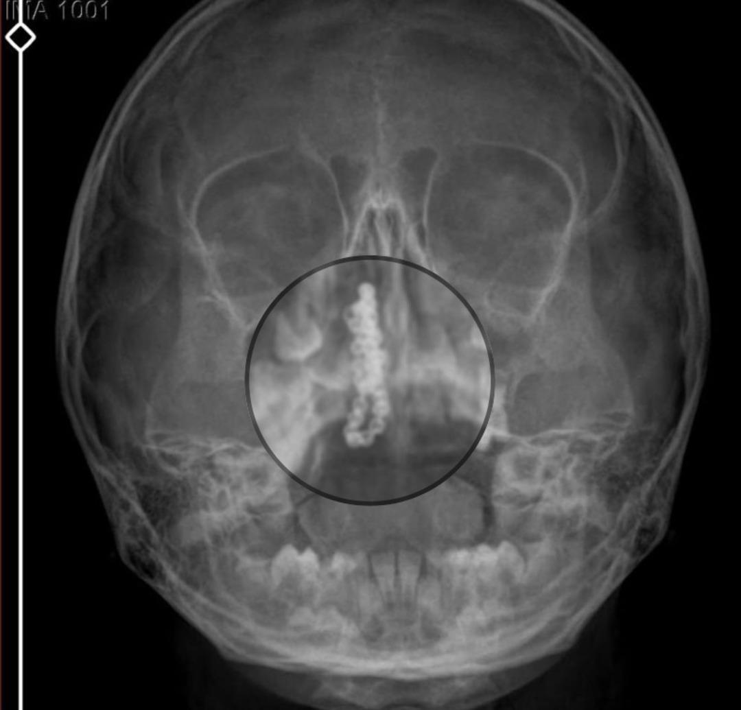5 yaşındaki Polen in 2 yıl boyunca burnundaymış!  Bu nasıl g&ouml;zden ka&ccedil;ılabilir?  2