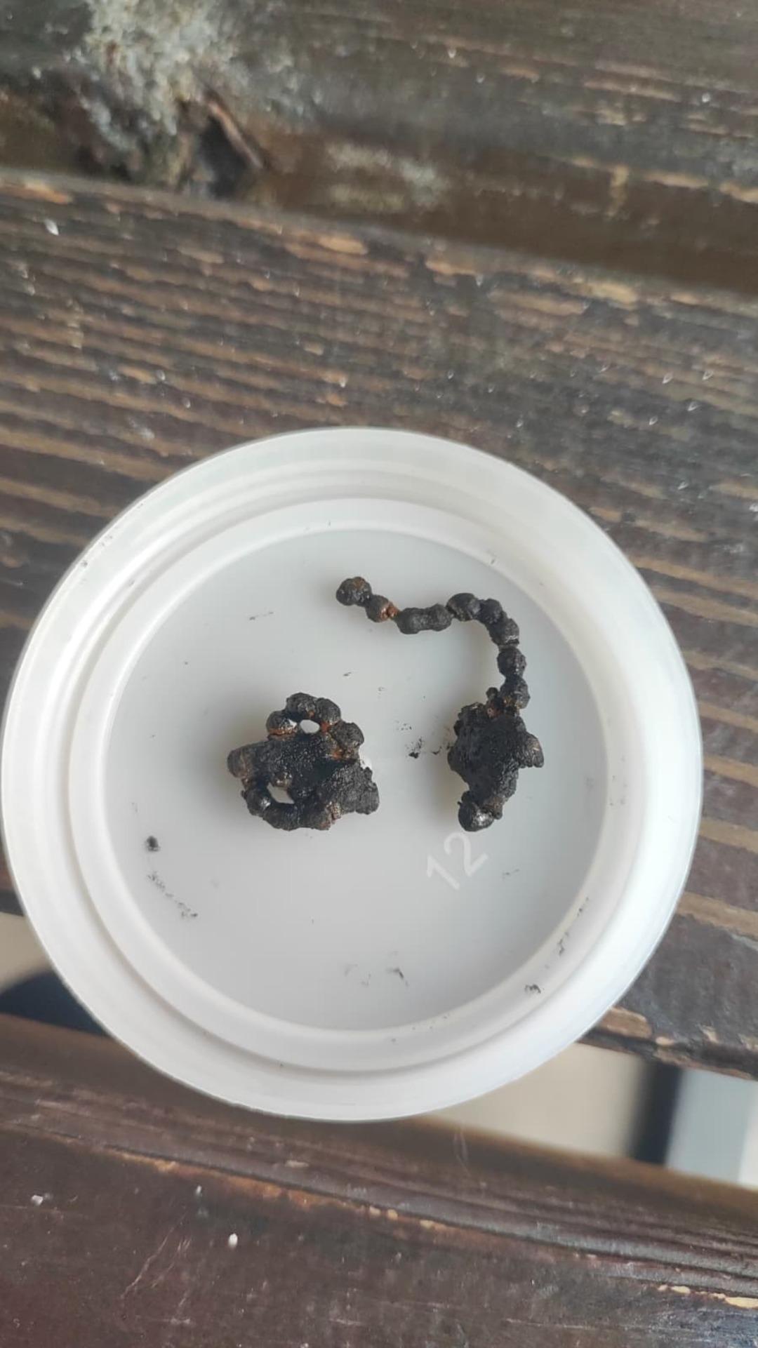 5 yaşındaki Polen in 2 yıl boyunca burnundaymış!  Bu nasıl g&ouml;zden ka&ccedil;ılabilir?  3