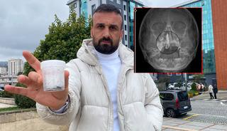 5 yaşındaki Polen'in 2 yıl boyunca burnundaymış!