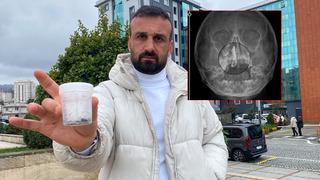 5 yaşındaki Polen'in 2 yıl boyunca burnundaymış! 'Bu nasıl gözden kaçılabilir?'