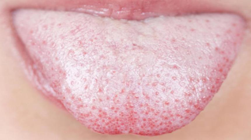 Dilinizin rengi beyazsa aman dikkat! Beyaz dil hastalık habercisi