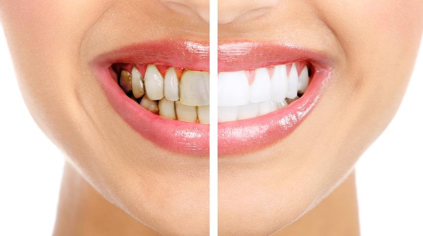 Yemekten hemen sonra diş fırçalamayın