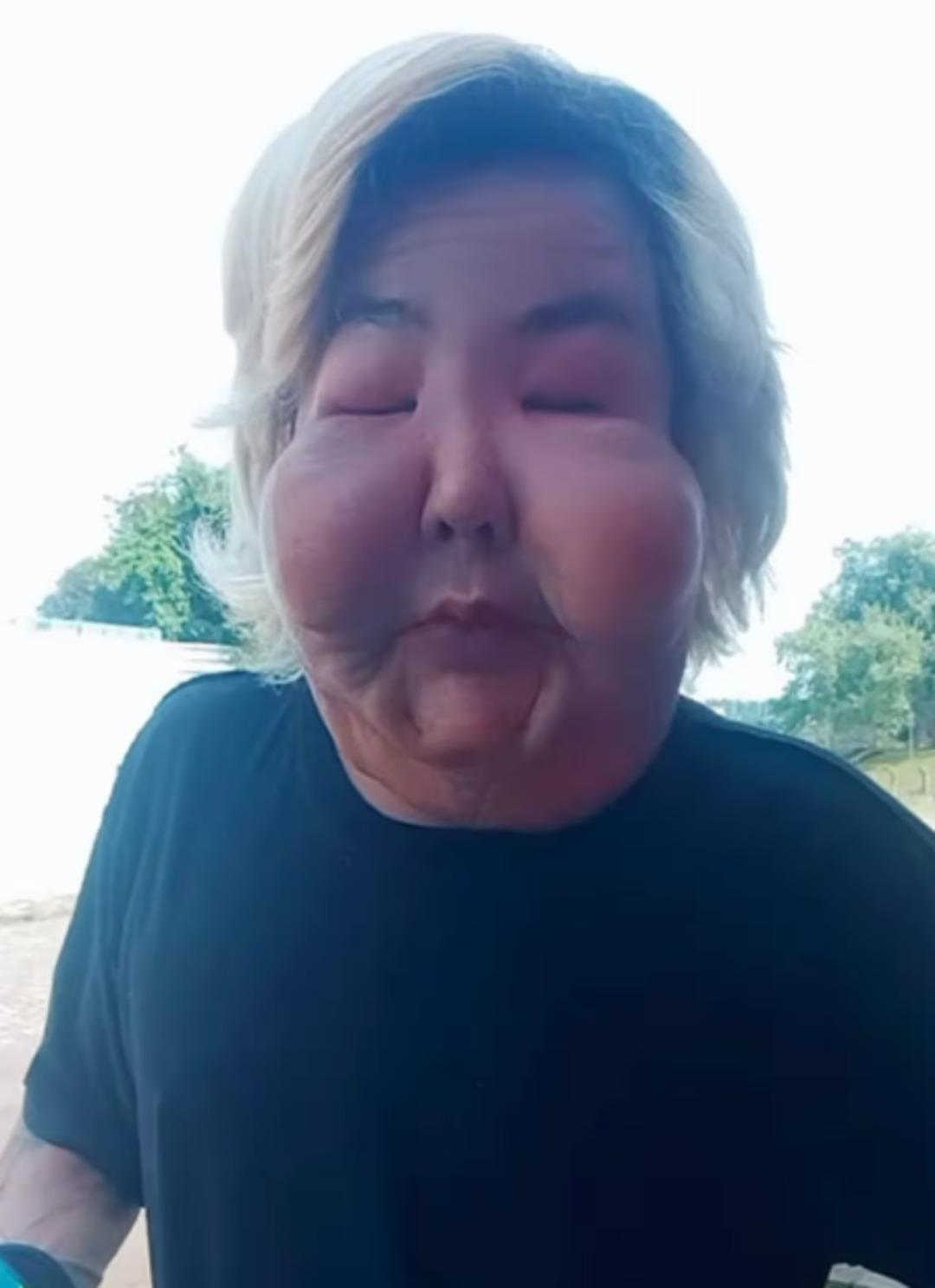 Estetikten yüzü şişip erimişti! Şimdi de göğüslerini yaptırdı 1