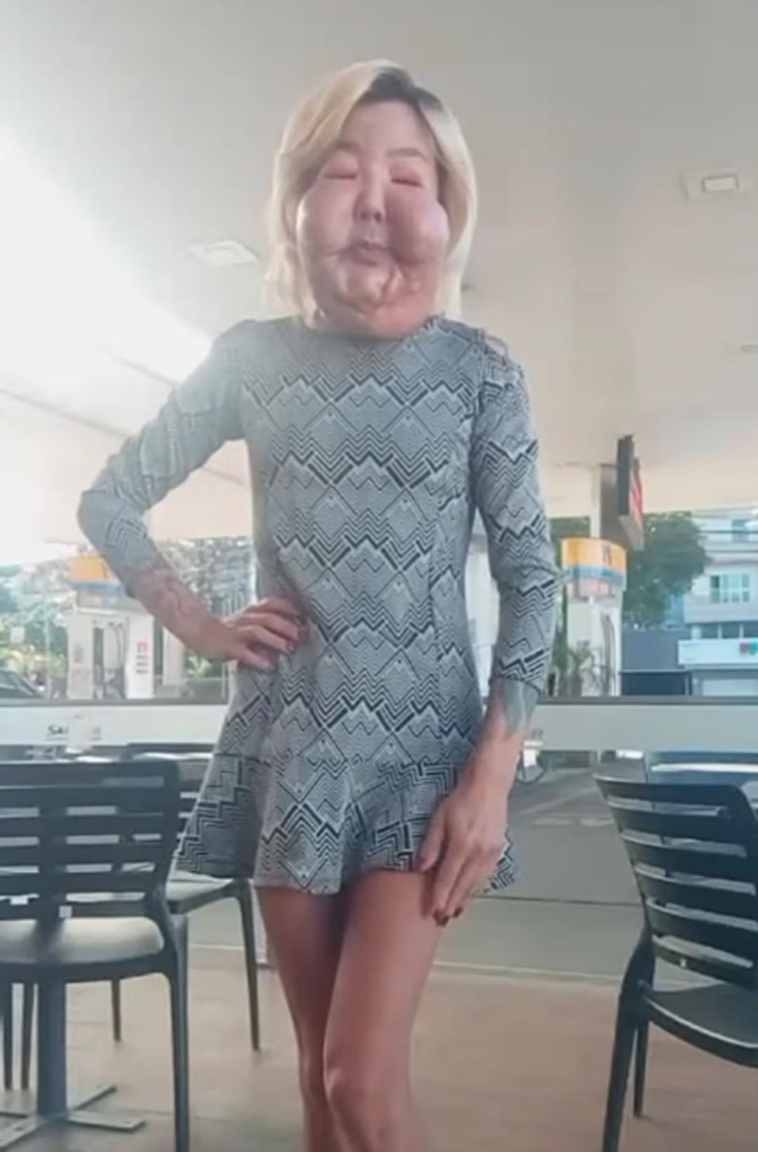 Estetikten yüzü şişip erimişti! Şimdi de göğüslerini yaptırdı 2