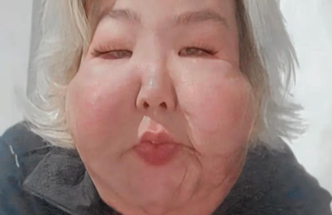 Estetikten yüzü şişip erimişti! Şimdi de göğüslerini yaptırdı 4