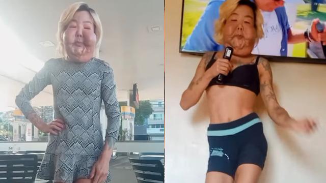 Estetikten yüzü şişip erimişti! Şimdi de göğüslerini yaptırdı