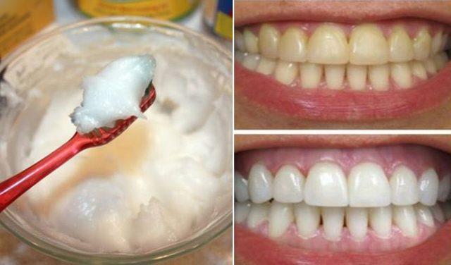 Home-Remedy-for-Super-Fast-Teeth-Whitening-with-Coconut-Oil-and-Baking-Soda