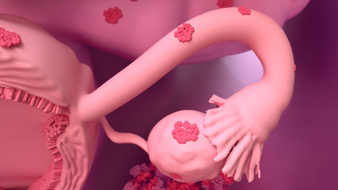 Tanı konulması 7-10 yılı bulabiliyor: Ağrısı &ccedil;ok, tanısı ge&ccedil; hastalık! 1