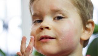 Egzaması olan bebekler i&ccedil;in altın değerinde tavsiyeler 