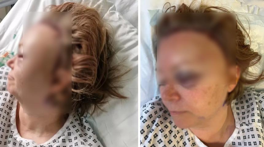 Yıllarca fark edilmedi: Bir anda fenalaştı! Beyninde anevrizma olduğu ortaya &ccedil;ıktı