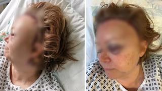 Yıllarca fark edilmedi: Bir anda fenalaştı! Beyninde anevrizma olduğu ortaya çıktı