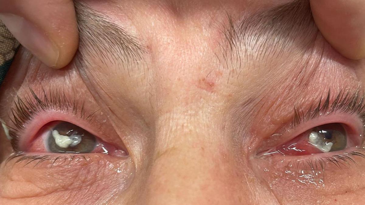 Kırlangıç otu felaketi: Gözlükten kurtulmak istedi, gözlerini açamaz hale geldi!