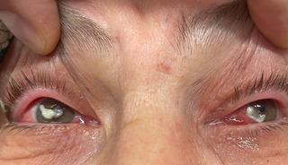 Kırlangı&ccedil; otu felaketi: G&ouml;zlerini a&ccedil;amaz hale geldi!