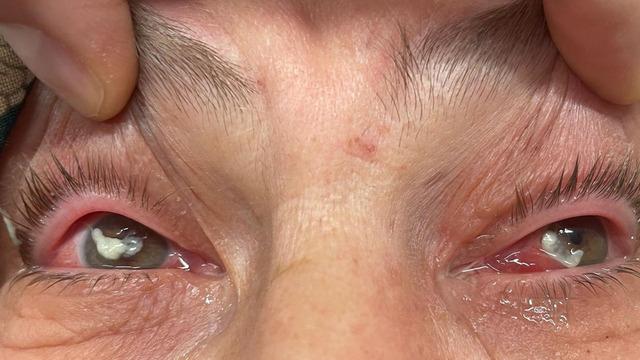 Kırlangıç otu felaketi: Gözlükten kurtulmak istedi, gözlerini açamaz hale geldi!