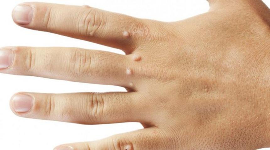 Siğiller ve benleriniz sizi rahatsız ediyorsa işte 3 etkili y&ouml;ntem