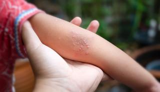 Cam bardak testiyle anlaşılabiliyor! Menenjitte hayati uyarı