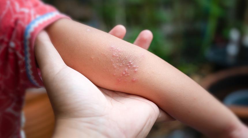 Cam bardak testiyle anlaşılabiliyor! Menenjitte hayati uyarı