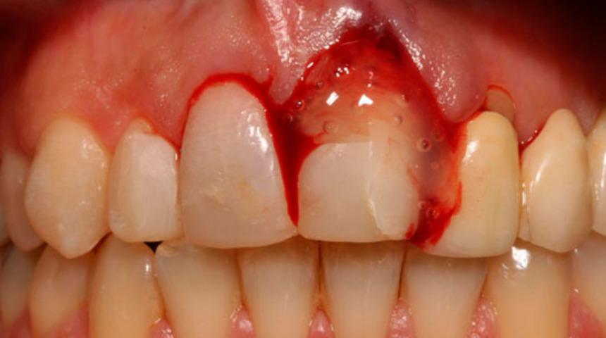 Hipokrat ta kullanmış! Vervain bitkisinin faydaları...