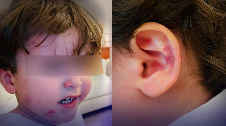 Gemlik&rsquo;te &ouml;zel kreşte skandal! 2,5 yaşındaki &ccedil;ocuk darp edildi, ailesi g&ouml;r&uuml;nce şoke oldu