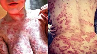 Sedef hastalığıyla mücadele eden model, ilham kaynağı olmak istiyor