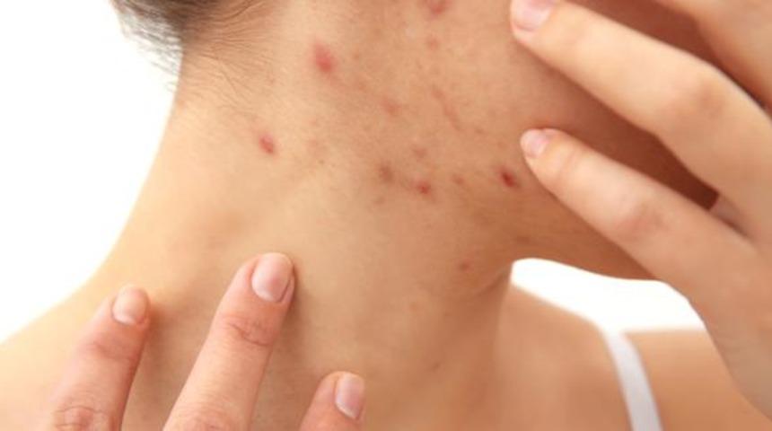 Yüzündeki sivilcelerle dalga geçen eşine boşanma davası açtı