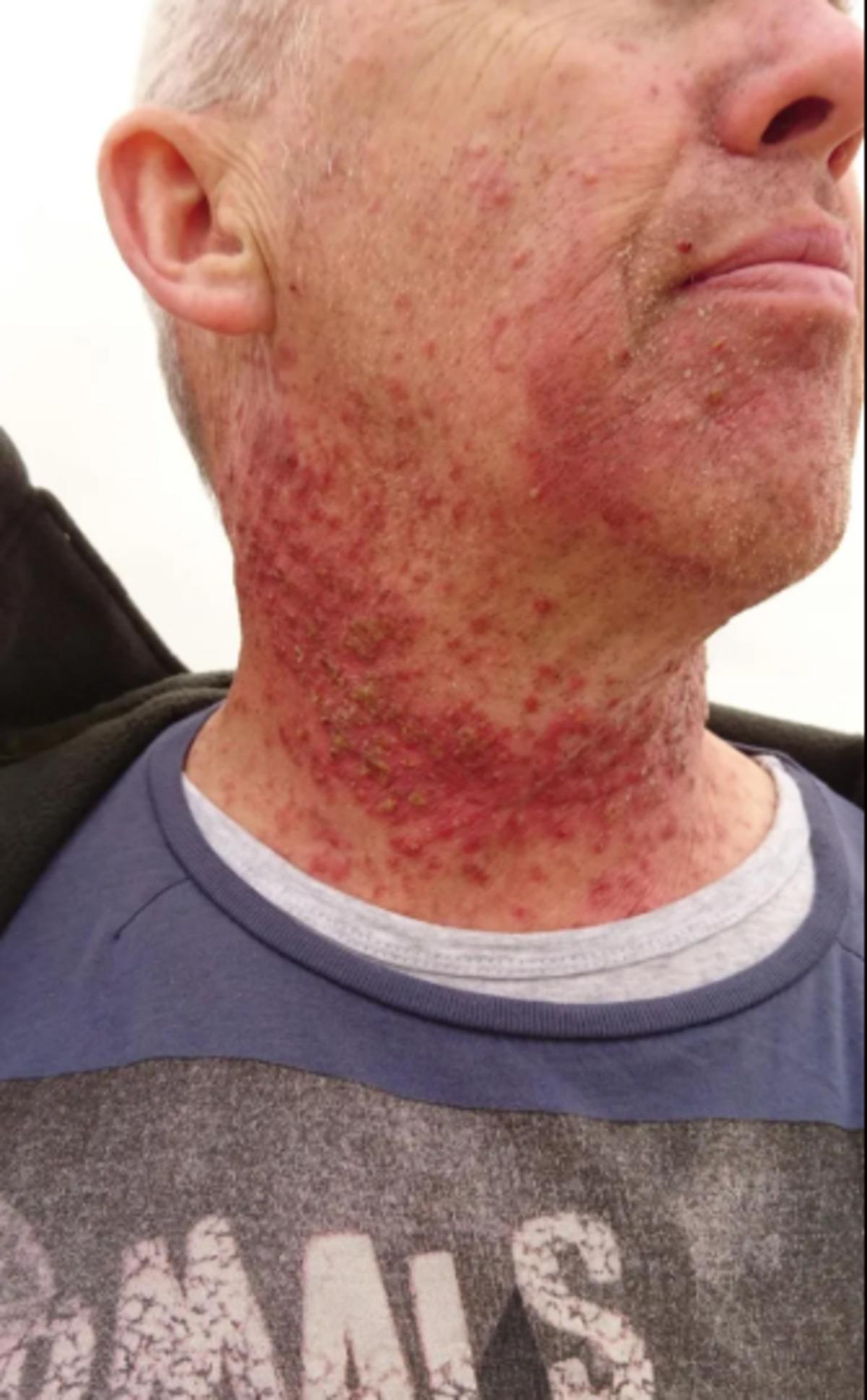 Boğaz ağrısı sandı ileri evre kanser çıktı! Sebep olan hastalık şaşırttı 1