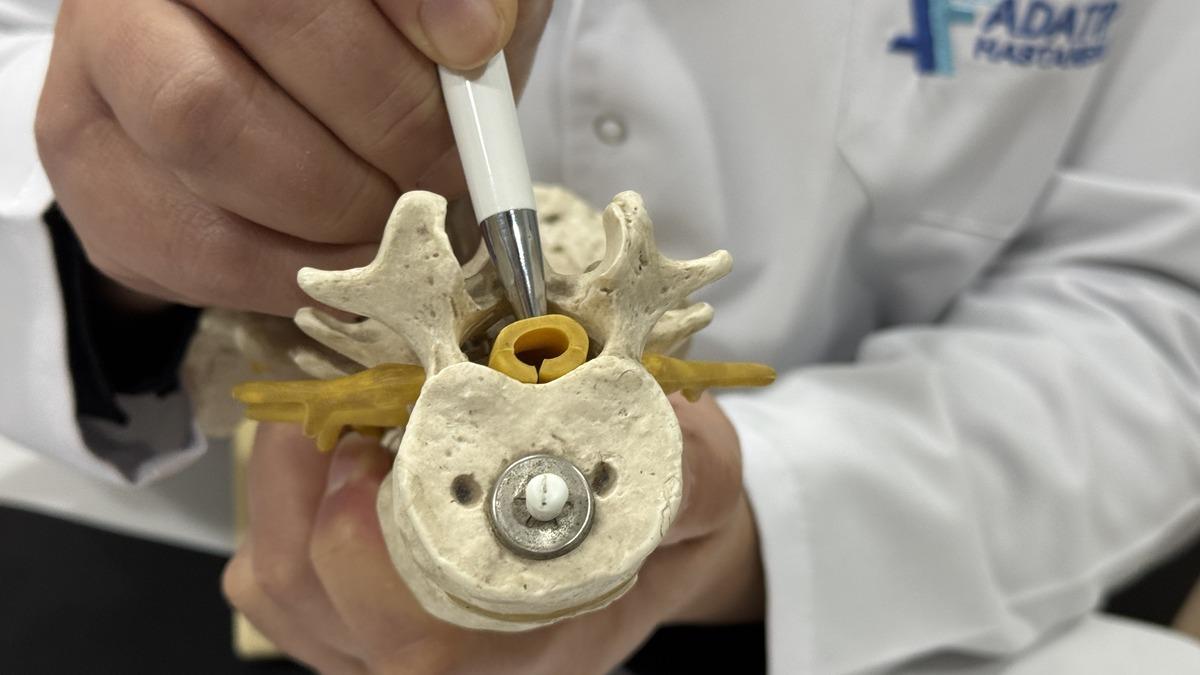 Bel fıtığıyla aynı belirtileri olan sinsi hastalık: Spinal stenoz 4