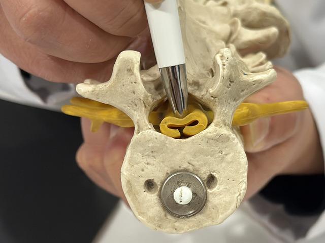 Bel fıtığıyla aynı belirtileri olan sinsi hastalık