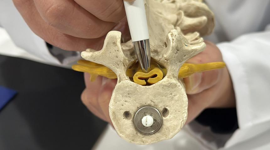 Bel fıtığıyla aynı belirtileri olan sinsi hastalık: Spinal stenoz