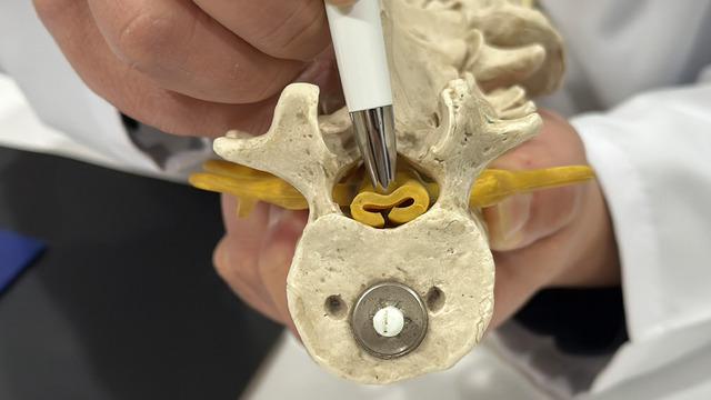 Bel fıtığıyla aynı belirtileri olan sinsi hastalık: Spinal stenoz