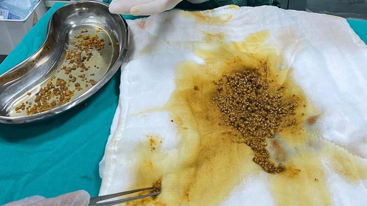 Karın ağrısıyla gitti, çıkanlar şok etti! Safra kesesinden 2 bin 67 taş çıkarıldı