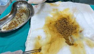 Karın ağrısıyla gitti, &ccedil;ıkanlar şok etti! Safra kesesinden 2 bin 67 taş &ccedil;ıkarıldı