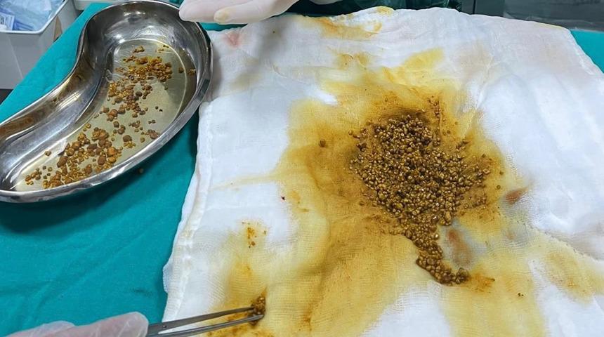 Karın ağrısıyla gitti, &ccedil;ıkanlar şok etti! Safra kesesinden 2 bin 67 taş &ccedil;ıkarıldı