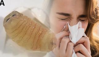 Hapşırınca solucan &ccedil;ıkardı! 'İmkansız' denen vaka