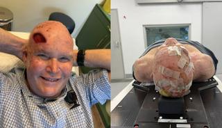 Doktorlar 6 ay &ouml;m&uuml;r bi&ccedil;mişti: Hastalıkla 7 senedir savaşıyor!