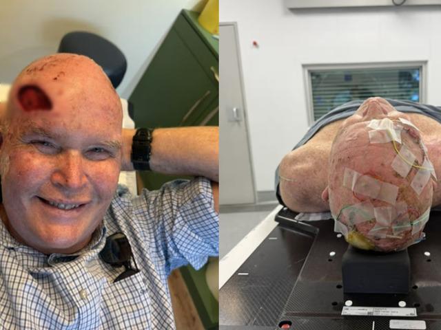 Doktorlar 6 ay &ouml;m&uuml;r bi&ccedil;mişti: Hastalıkla 7 senedir savaşıyor!