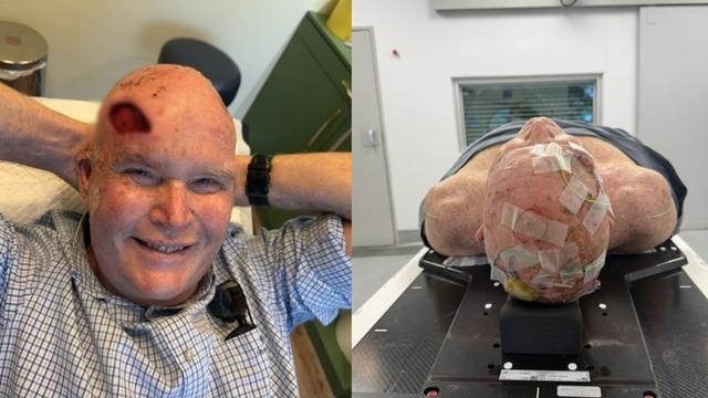 Doktorlar 6 ay ömür biçmişti: Hastalıkla 7 senedir böyle savaşıyor!