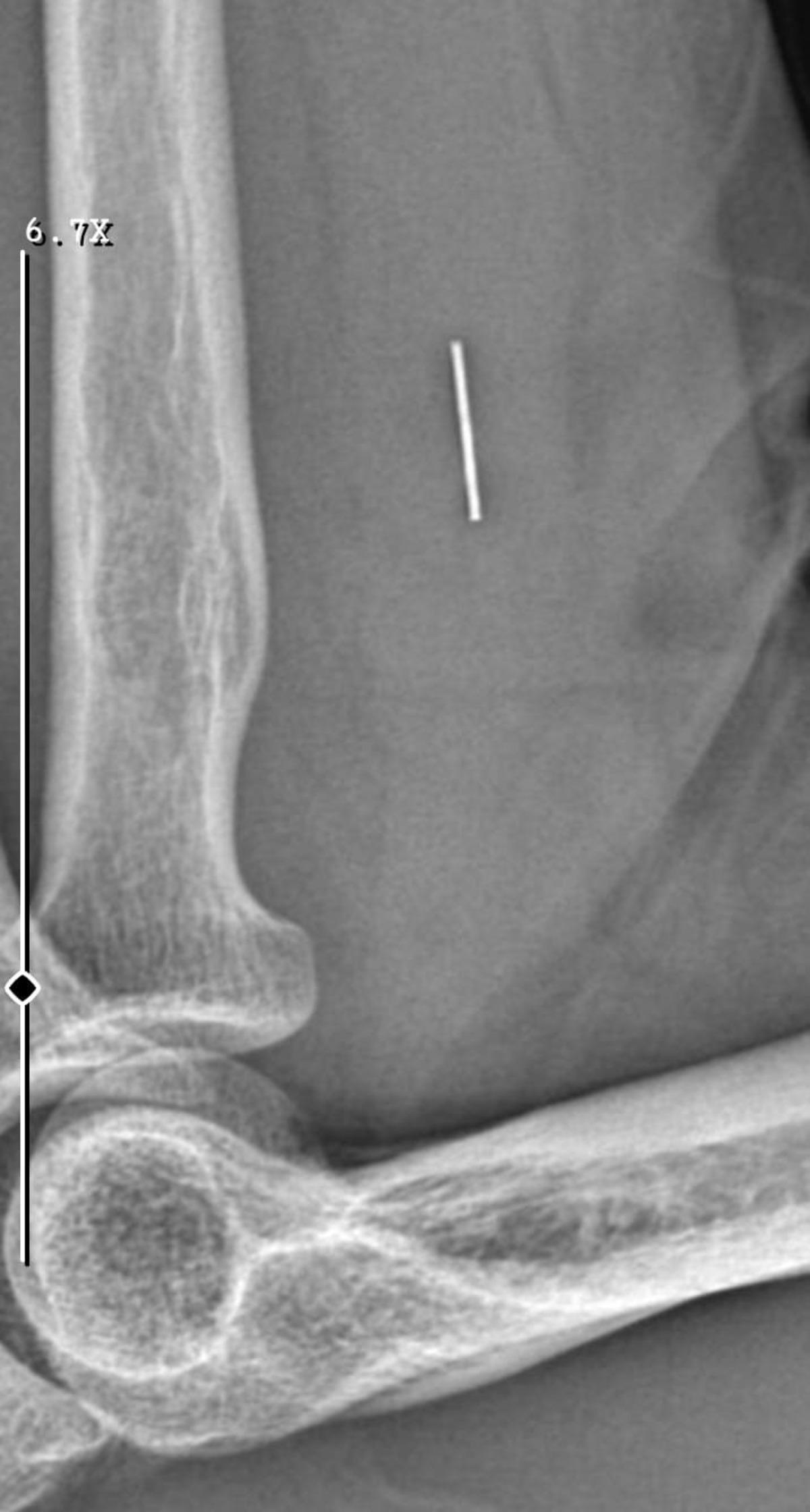 "İyiye gidiyor" dediler, parmağı çürüdü: Kolunda metal parça unutuldu! İhmaller zinciri hayatını kabusa çevirdi 4