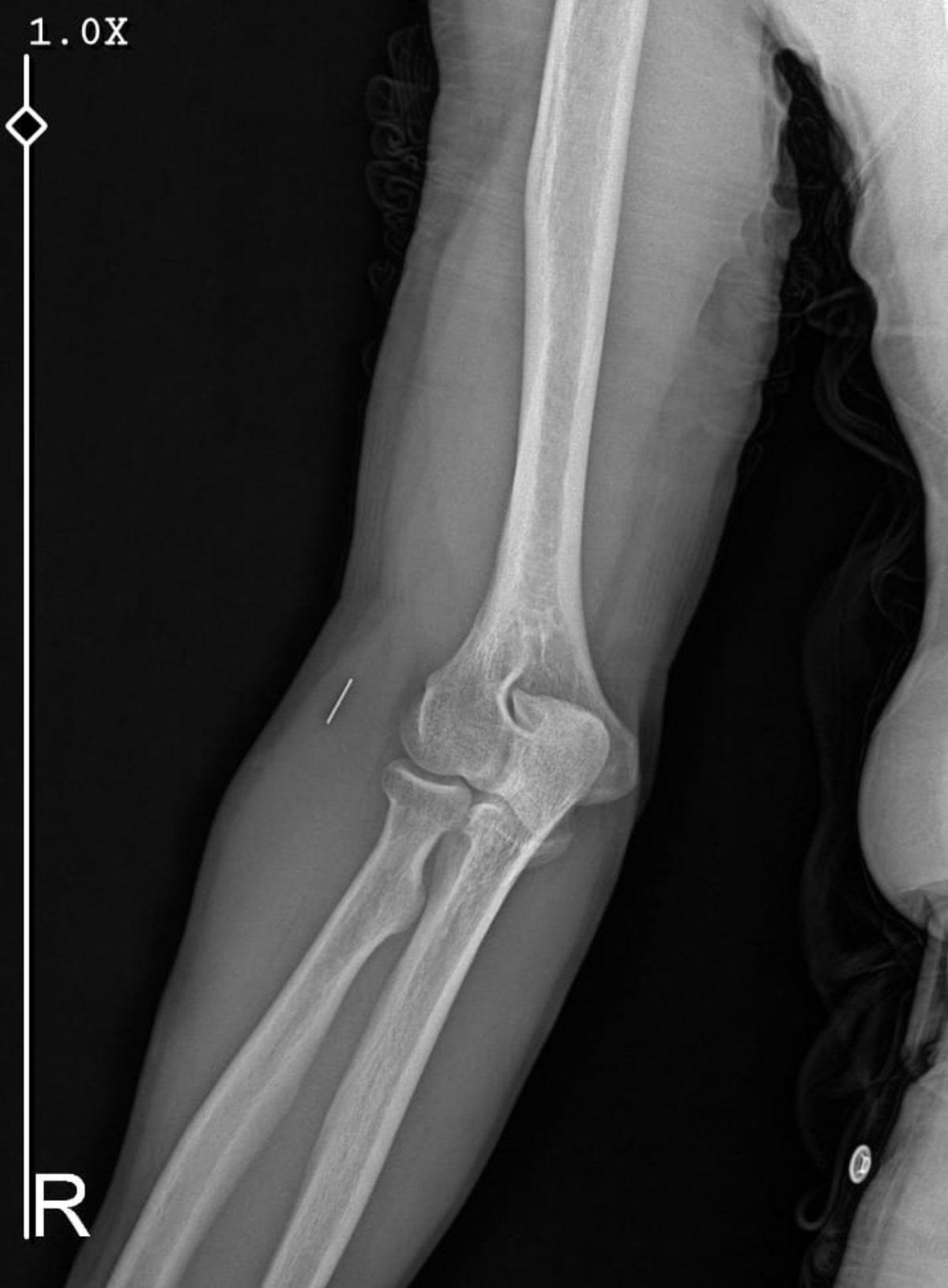 "İyiye gidiyor" dediler, parmağı çürüdü: Kolunda metal parça unutuldu! İhmaller zinciri hayatını kabusa çevirdi 5