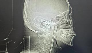 Ağrı şikayetiyle doktora gitti: Boğazından &ccedil;ıkana doktor da inanamadı! Tam 12 santimetre