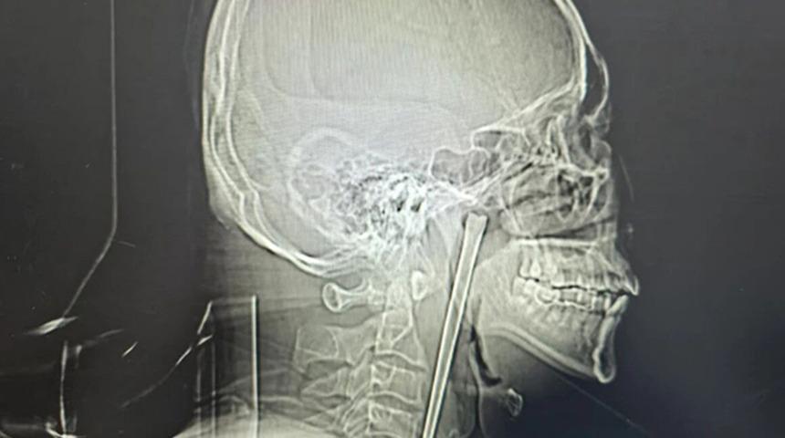 Ağrı şikayetiyle doktora gitti: Boğazından &ccedil;ıkana doktor da inanamadı! Tam 12 santimetre