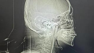 Ağrı şikayetiyle doktora gitti: Boğazından çıkana doktor da inanamadı! Tam 12 santimetre