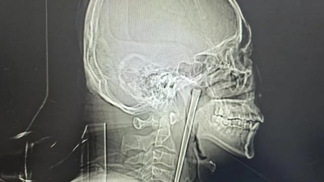 Ağrı şikayetiyle doktora gitti: Boğazından çıkana doktor da inanamadı! Tam 12 santimetre