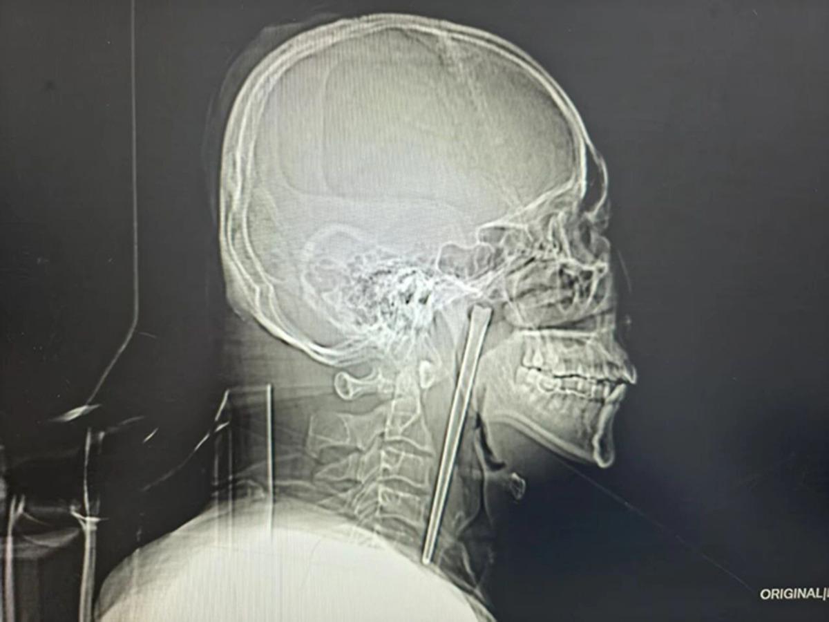 Ağrı şikayetiyle doktora gitti: Boğazından &ccedil;ıkana doktor da inanamadı! Tam 12 santimetre 1