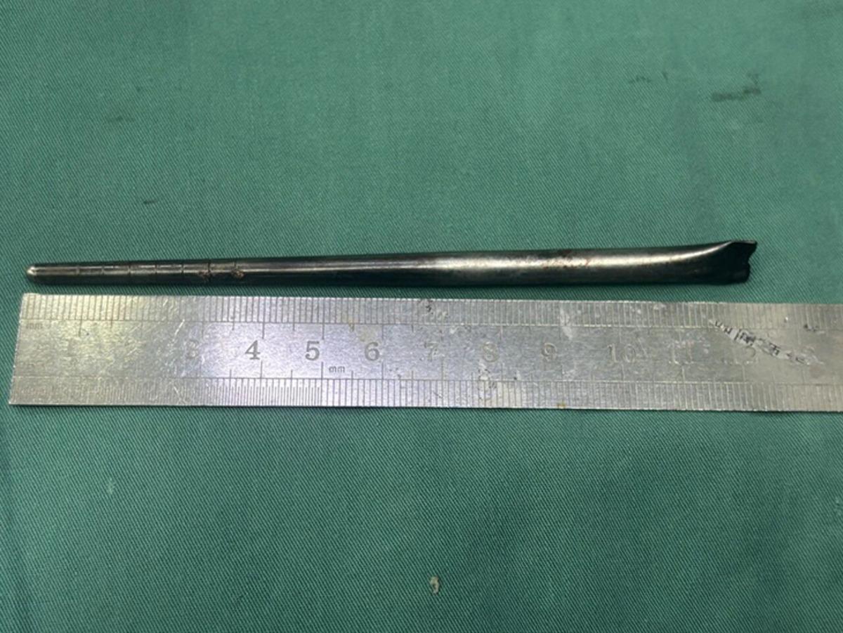 Ağrı şikayetiyle doktora gitti: Boğazından &ccedil;ıkana doktor da inanamadı! Tam 12 santimetre 2