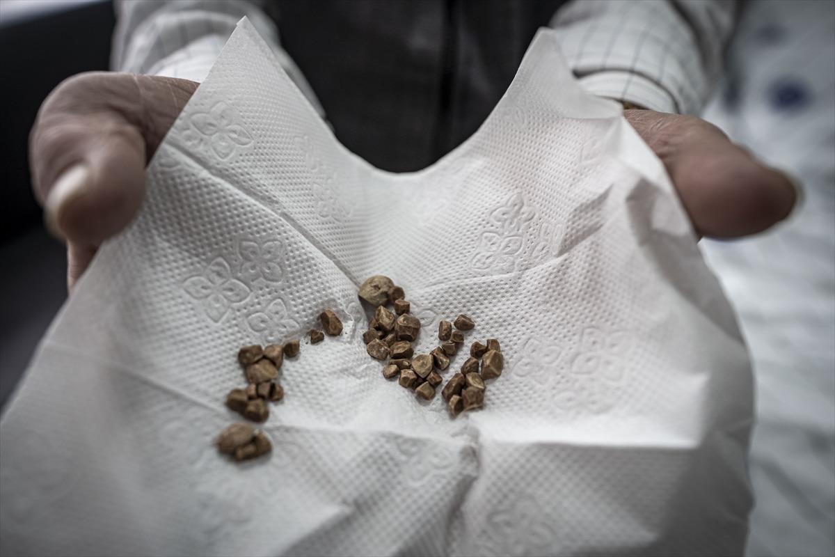 2 &ccedil;ocuk annesi kadının v&uuml;cudundan &ccedil;ıkarıldı! Tam 51 tane... "İlk kez g&ouml;rd&uuml;m" 2