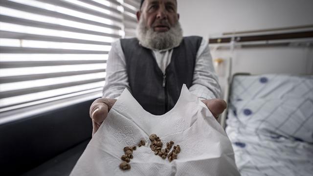 2 çocuk annesi kadının vücudundan çıkarıldı! Tam 51 tane... İlk kez gördüm