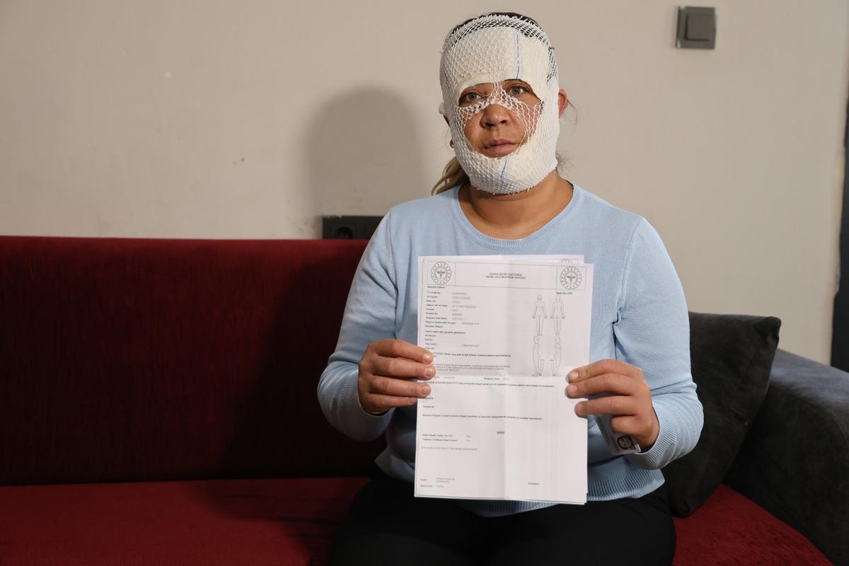 Adı  Prenses  sonucu kabus: Oğlu bile "&ouml;c&uuml;" sandı! 7 bin liralık yanık 1